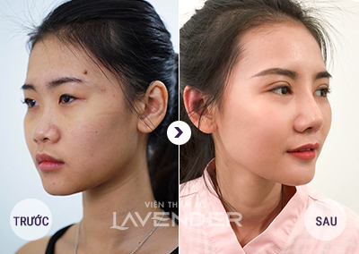 Dịch vụ PTTM mũi