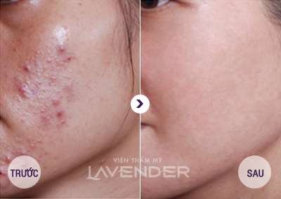 Dịch vụ trị mụn, sẹo