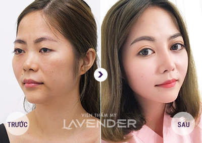 Dịch vụ trị nám, tàn nhang